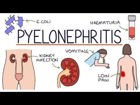 Understanding Pyelonephritis (Kidney Infections)