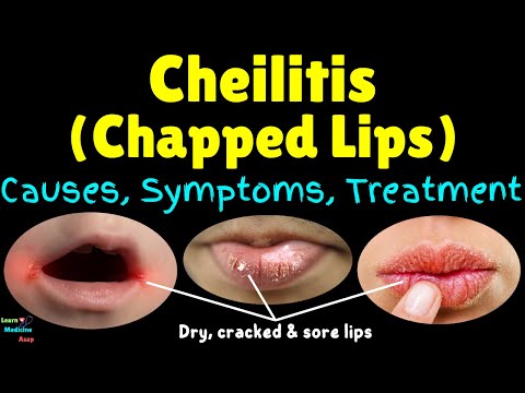 Cheilitis (Chapped Lips): Causes, Symptoms, Treatment, Prevention & Home Remedies for Chapped Lips