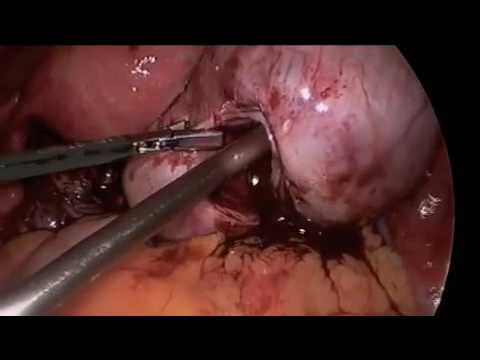 endometriosis laparoscopy  YouTube 360p