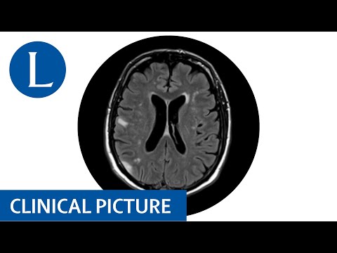 Myocloni, status epilepticus, confusion, and drowsiness