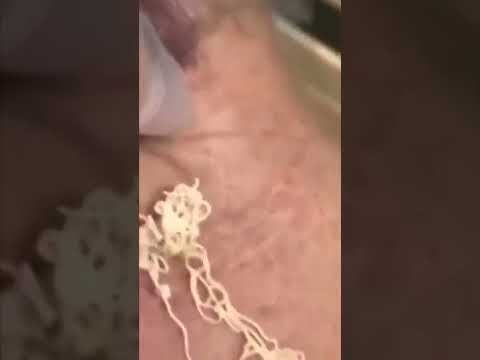 large blackheads this week Removing of Blackheads