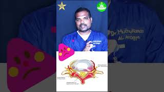 ligamentum flavum thickening tips | #tamilhealthtips #tamilhealthtipsvideos