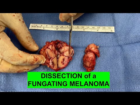 DISSECTION of a FUNGATING TUMOR aka MELANOMA in the OPERATING ROOM