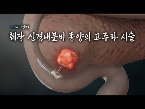 [명의 의학백과📖] 췌장 신경내분비 종양의 고주파 시술