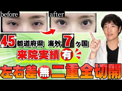 【二重全切開】施術後の左右差が" ほぼ0 "の独自の二重全切開法とは？【RYAN式1day全切開】