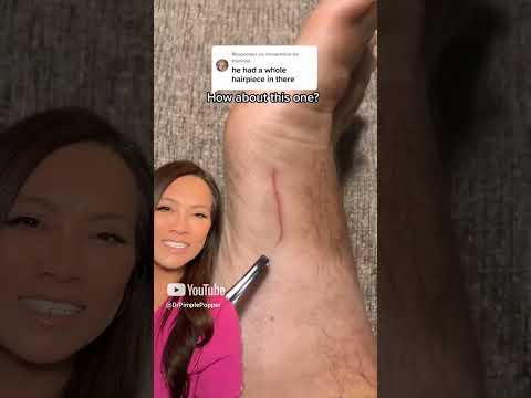 Dr. Pimple Popper Reacts to Inflamed Ingrown That Looks SATISFYING to Pull Out