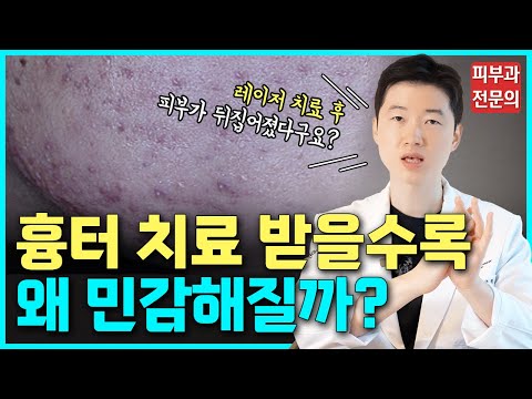 여드름 흉터 치료 잘못된 시술로 피부가 민감해지셨나요? #피부 #여드름