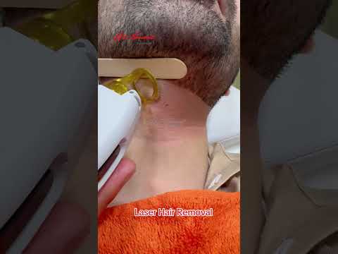 Laser Hair Treatment #getsmarthairclub #viralvideo #skincare