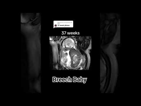 37 Weeks breech baby #breechbaby #babyultrasound #baby #pregancyultrasound