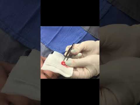 A Near Ear Cyst Squeeze