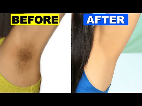 How to Get Rid of Dark Underarms | Home Remedies to Lighten Dark Underarms.