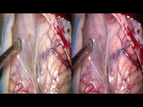 The suboccipital, telovelar, transsuperior fovea approach to dorsal pontine lesions