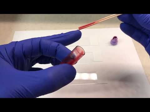 Peripheral Blood Smear: Common Ways of Making a Blood Drop.