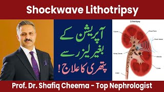 Lithotripsy for Kidney Stones | Shockwave lithotripsy - SWL #ESWL #SWL #lithotripsy