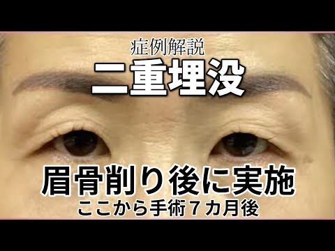 眉下切開から眉骨を削って、そこから二重埋没術。名古屋こいずみ形成クリニック症例解説