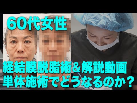 【衝撃BeforeAfter!施術風景公開！】60代だと脱脂だけはNGなのか？脱脂のみのクマ治療をしたモニターさんをご紹介（解説付き）