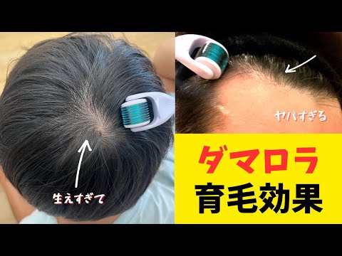 【ミノキシジル】３年使ってわかったダーマローラーの育毛効果と正しい使い方【再放送】