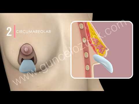 How breast lifting operation is performed?  3D Animation - Dr. Guncel Ozturk #DRGO