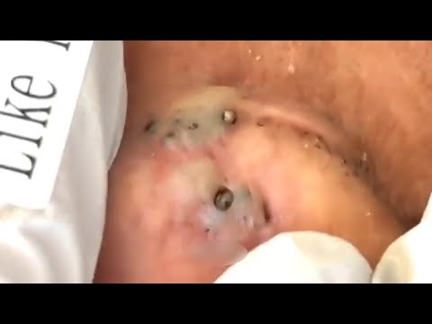 (7 Intense Blackhead Removal videos) | Poppy TV Ep#1 | viral video compilation