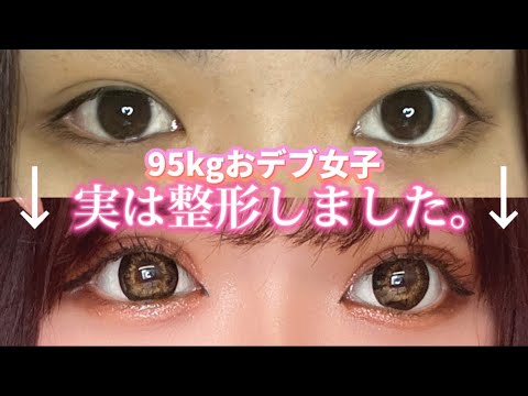 【二重整形】９５ｋｇおデブ女子埋没します！ダウンタイムも公開！