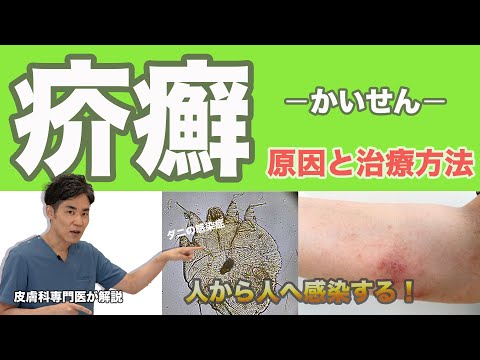 【乾癬と疥癬②】疥癬（かいせん）人から人へと感染！？