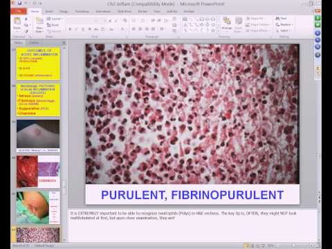 Medical School Pathology, 2013 Season, Session #4: Inflammation