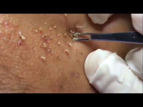 Deep Acne Removal By Expert, Milia, How to Removal Deep Acnes