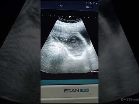 pregnancy #ultrasound #health #science #ultrasoundtech #medicalultrasound