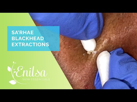 Sa’Rhae Blackhead Extractions