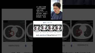 ＜がん遺伝子治療＞⑳肺がんステージ4　60代男性　経過１　「がん遺伝子治療（RNA干渉療法）実際の症例」よりYouTubeショート #shorts