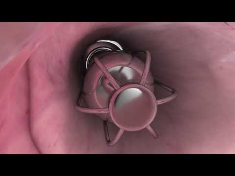 MedArt Laser Vaginal Rejuvenation