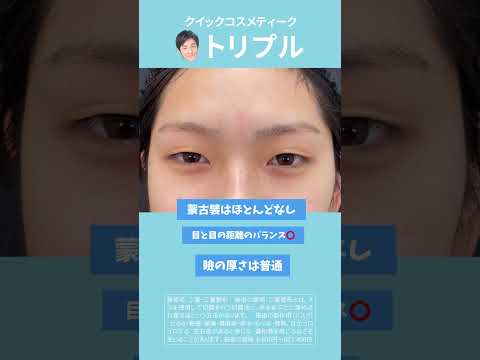 形成外科専門医が行う二重術！！二重のことなら大宮東口院福田医師にお任せ！クリニック大人気のクイックコスメティークトリプルであなたも理想の二重に！#形成外科専門医 #二重整形 #二重埋没