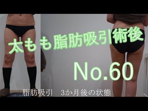 60代女性　脂肪吸引3か月後の状態60