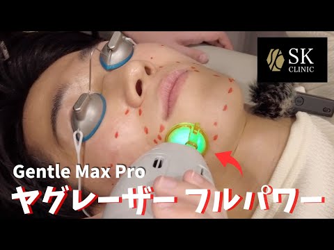 【SKクリニック】Gentle Max Proヤグレーザーで髭脱毛してみた結果がヤバすぎた・・・