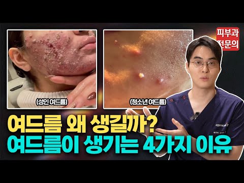 여드름 때문에 '이것' 생기게 되면 평생 완치가 힘듭니다 / 여드름 관리, 여드름 교정