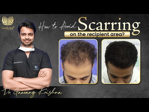 Scarring on Recipient Area😱 HAIR TRANSPLANT GONE ❌WRONG ✅Best Hair Transplant in India | Medlinks