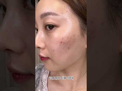 Adult acne is gone! #Skin care for acne