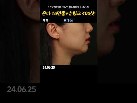 온다 16만줄+슈링크 400샷