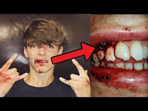 My WORST Injury… (STORYTIME)