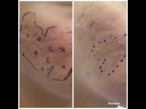 顯微磨皮與精準皮下剝離 acne scar Micro-dermabrasion and precise submission: icepick scar and boxcar scar