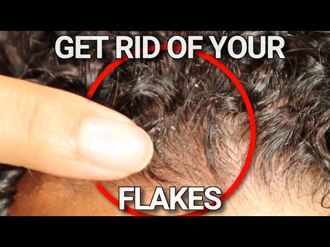 Why your scalp is flaky and HOW to FIX it