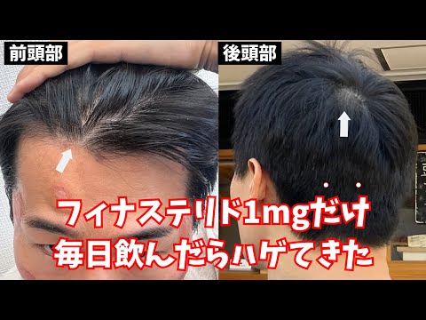 【4ヶ月】フィナステリド1mgだけ毎日飲んだらハゲてきました【薄毛・AGA治療経過報告】