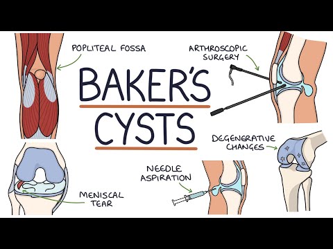 Understanding Baker's Cysts (Popliteal Cysts)