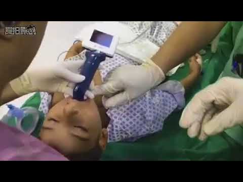 Video Laryngoscope: Intubation in Children