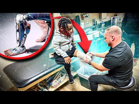 Rich Takes First Step To Getting Prosthetic Leg (Road To Recover)