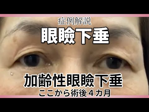 眼瞼下垂４か月