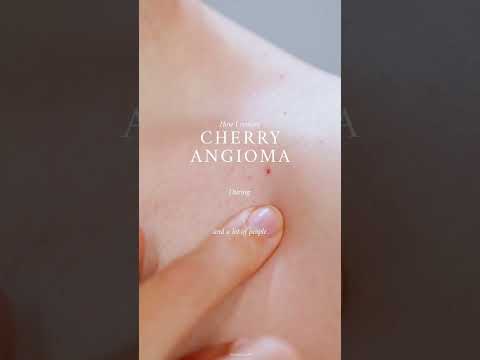 What is Cherry Angiomas 🩸 + How  To Treat Them + Demo #shorts