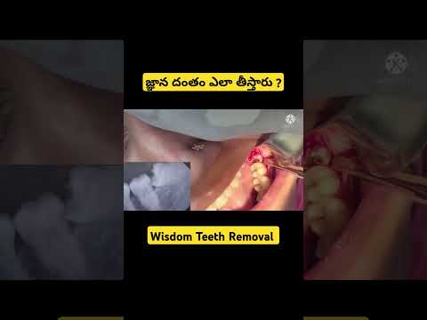 How  Wisdom Teeth is Removed ? జ్ఞాన దంతం ఎలా తీస్తారు ? #shorts #ytshorts #saanvidental #trending