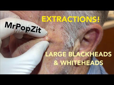 Awesome acne extractions! Some solar comedones (Favre), some regular blackheads and whiteheads