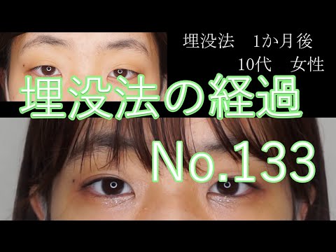 埋没法　133　10代女性　3か月目まで